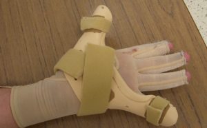 Wearing Splints For Burn Injuries - Beyond Burns